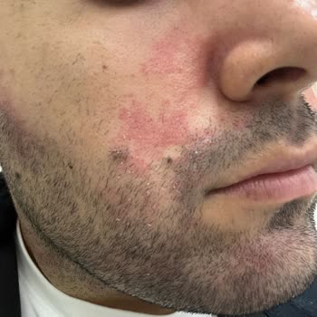 Dermatoloji Tedavisinde Etkisiz Sonuç Ve İletişim Sorunları Nedeniyle Doktor Değişikliği Talebi