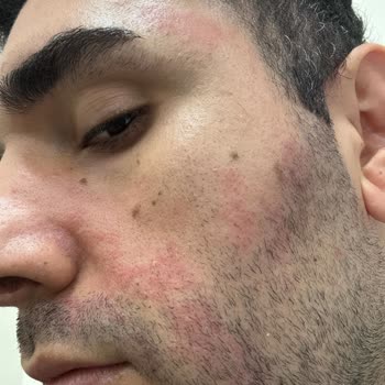 Dermatoloji Tedavisinde Etkisiz Sonuç Ve İletişim Sorunları Nedeniyle Doktor Değişikliği Talebi