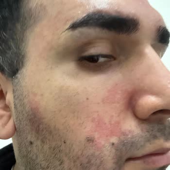 Dermatoloji Tedavisinde Etkisiz Sonuç Ve İletişim Sorunları Nedeniyle Doktor Değişikliği Talebi