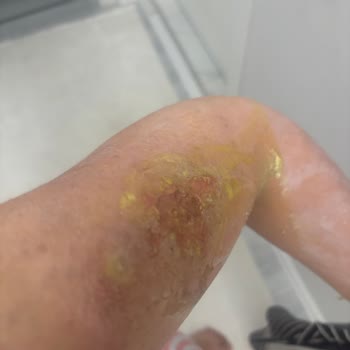 Aris Şubesinde Cilt Bakımı Sonrası 2. Derece Yanık Ve Tazminat Talebi