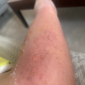 Aris Şubesinde Cilt Bakımı Sonrası 2. Derece Yanık Ve Tazminat Talebi