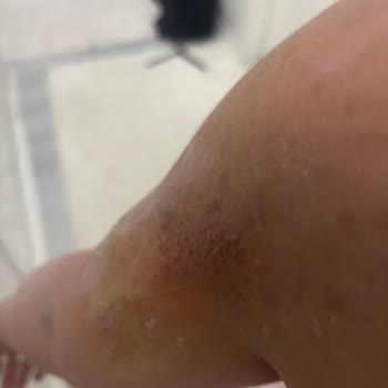 Aris Şubesinde Cilt Bakımı Sonrası 2. Derece Yanık Ve Tazminat Talebi