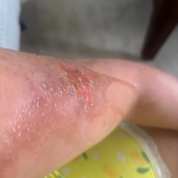 Aris Şubesinde Cilt Bakımı Sonrası 2. Derece Yanık Ve Tazminat Talebi
