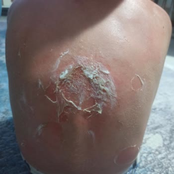 Nivea Sun Güneş Kremi Koruma Sağlamadı Ve Çocuğum Yanıldı