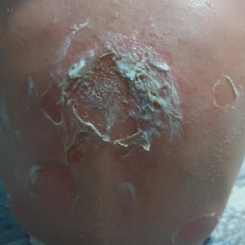 Nivea Sun Güneş Kremi Koruma Sağlamadı Ve Çocuğum Yanıldı