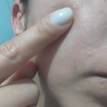 Yves Rocher Tonik Kullanımından Sonra Yüzümde Yağ Bezeleri Ve İade Talebi