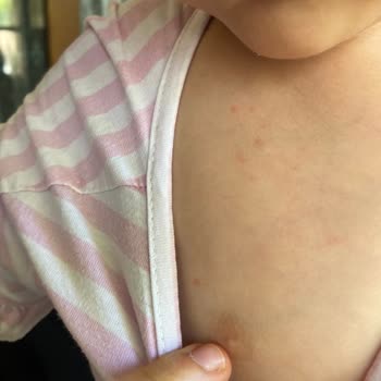 Balım Eczanesinin Önerdiği Şurup Alerjik Reaksiyon Ve İade Talebi
