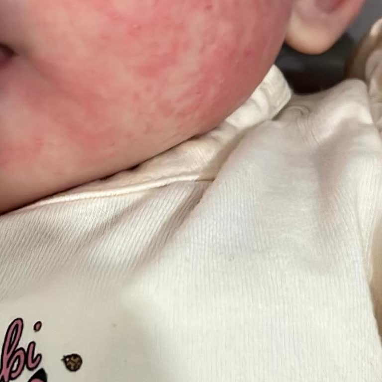 Bebek Güneş Kremi Cildinde Şiddetli Yanık Ve Tahriş Oluşturdu