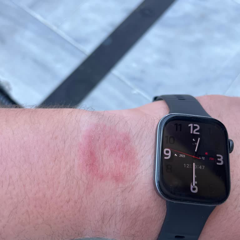Huawei Fit 3 Saati Nabız Sensöründen Kaynaklanan Yanık Benzeri Cilt Tahrişi