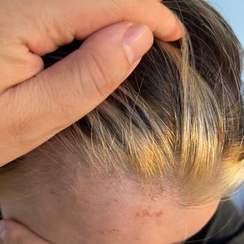 6.500 TL Ödemesi İçin Ombre Yanığı Ve İade Talebi