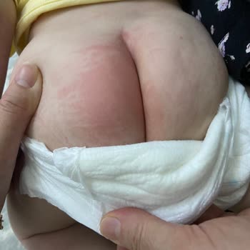 Sert İç Dolgu Nedeniyle Bebekte Kızarıklık Ve Tahriş, İade Talebi