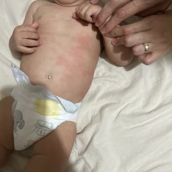 Mustela Şampuan Ve Nemlendiriciden Bebeğimde Alerjik Döküntü, Açıklama Ve Geri Dönüş Talebi