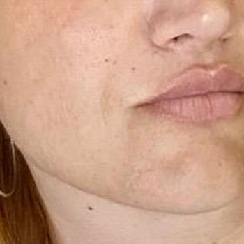 Kalıcı Makyaj Ve Kirpik Lifting İşlemlerinin Sonuç Vermemesi Ve Ücret İadesi Talebi