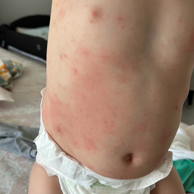 Bebelac 3 Kullanımından Sonra Bebekte Şiddetli Alerjik Reaksiyon Ve İade Talebi