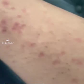 Epify Tüy Dökücü Krem Kızarıklık Yaptı