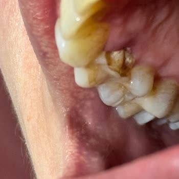 Kahve Dünyası Çikolatasındaki Sert Kakao Nibi Dişimi Kırdı