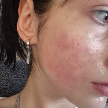 Yves Rocher Ürünleri Alerjik Reaksiyon Ve Ücret İadesi Talebi