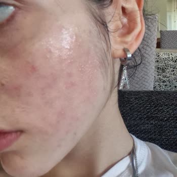 Yves Rocher Ürünleri Alerjik Reaksiyon Ve Ücret İadesi Talebi
