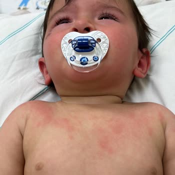 Enterogermina Kids Kullanımından Sonra Çocuğumda Şiddetli Alerjik Reaksiyon Ve Hastane Yatışı