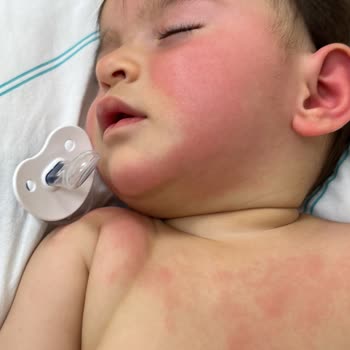 Enterogermina Kids Kullanımından Sonra Çocuğumda Şiddetli Alerjik Reaksiyon Ve Hastane Yatışı