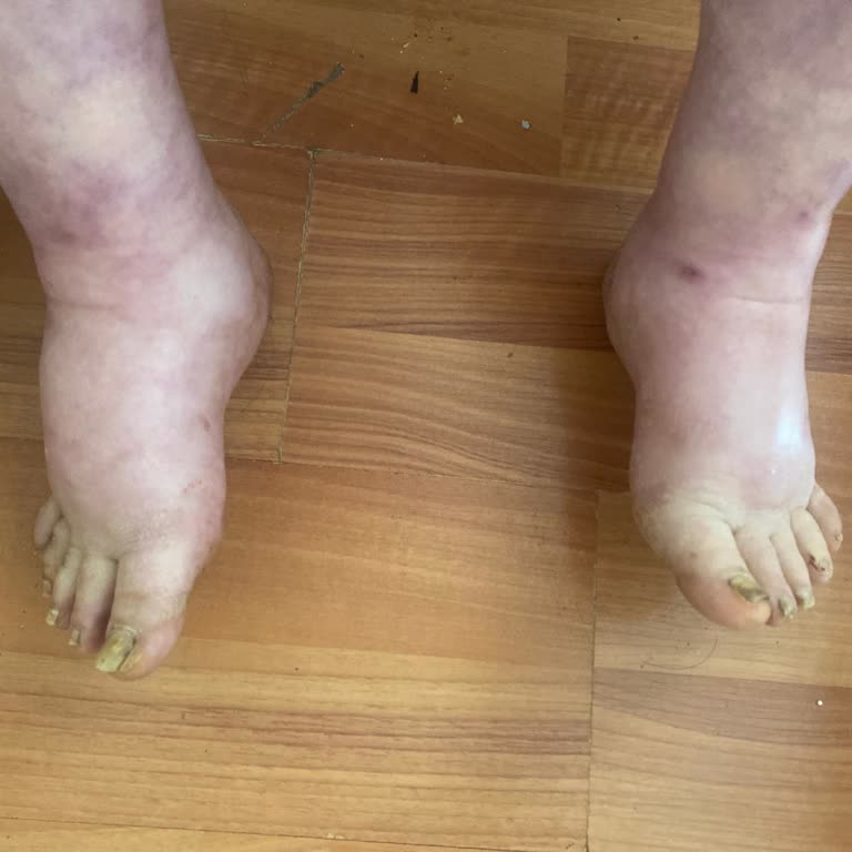 Acil Serviste Ciddi Ödemli Hastanın Durumu Hafife Alınması Ve Doktor Çağrılmaması