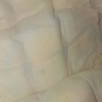 Sleepy Bebek Bezinde Yabancı Madde Ve Yetersiz Telafi