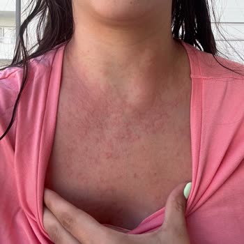 Bronzing Bomb SPF 0 Tek Kullanım Sonrası Şiddetli Alerji, Hastane Masrafı Ve Maddi Kayıp