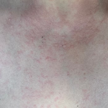 Bronzing Bomb SPF 0 Tek Kullanım Sonrası Şiddetli Alerji, Hastane Masrafı Ve Maddi Kayıp