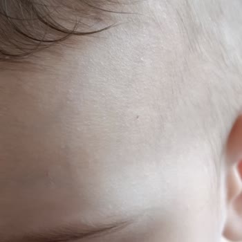 Bebek Cildinde Alerjik Reaksiyon Yaratan Bioderma Atoderm Nemlendirici