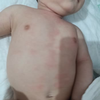 Bebek Cildinde Alerjik Reaksiyon Yaratan Bioderma Atoderm Nemlendirici
