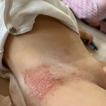Yeni Double Soft Bebeğimde Şiddetli Cilt Döküntüsü Ve Markadan Hiç Cevap Gelmedi