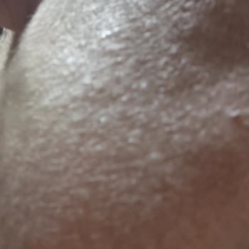 Rossmann Anyong Somon DNA Kremi Ciltte Şiddetli Alerjik Reaksiyon Ve İade Talebi