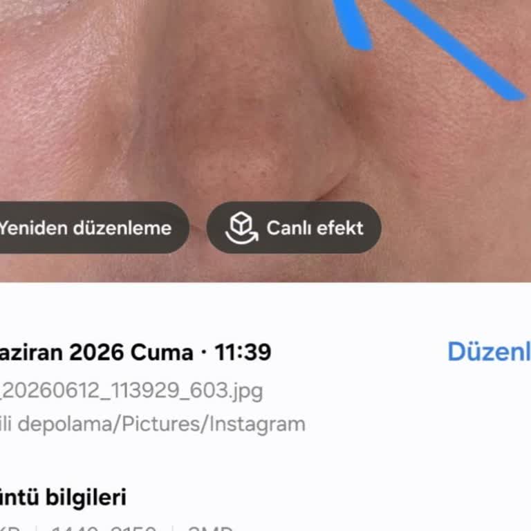 Op. Dr. Selçuk Yüce İki Ameliyat Sonrası Sürekli Burun Şişliği Ve Doktorun Sorumsuz Tutumu