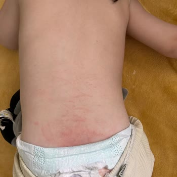 Prima Premium Care 5 Numaralı Bebek Bezinde Cilt Yanması Ve Pamuk Parçacıkları