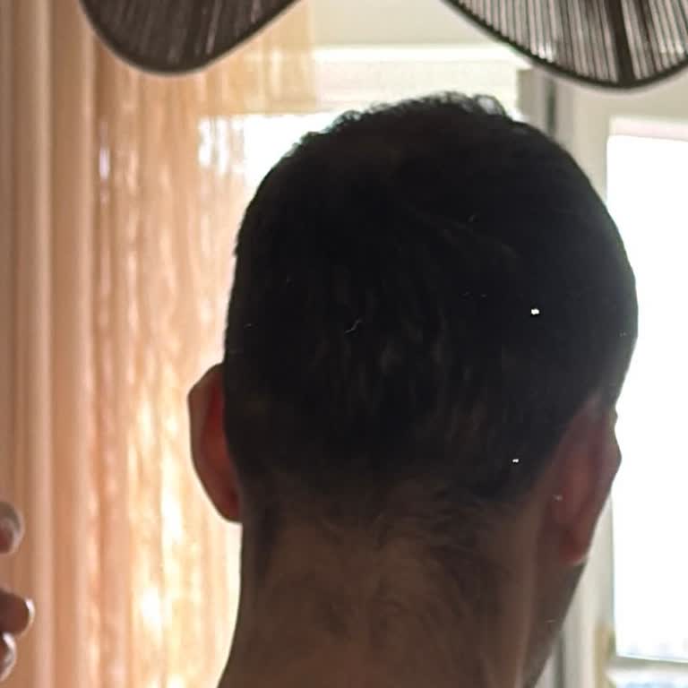 Zarinna Güzellik Merkezinde Yanıltıcı Lazer Epilasyon Ve İade Talebi