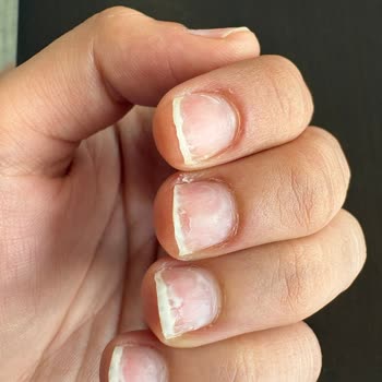 Aşırı Acı Ve Acele İşlem: Gratis Beauty'de 450 TL İade Talebi