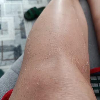 Celenes Güneş Kremi Kullanımından Şiddetli Yan Etki Ve Cilt Yanıkları