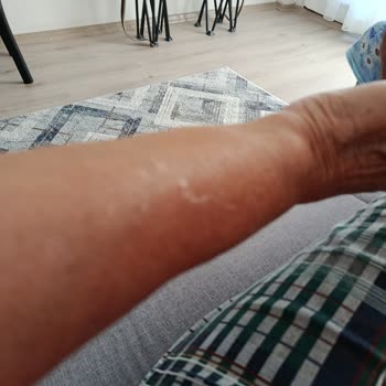 Celenes Güneş Kremi Kullanımından Şiddetli Yan Etki Ve Cilt Yanıkları