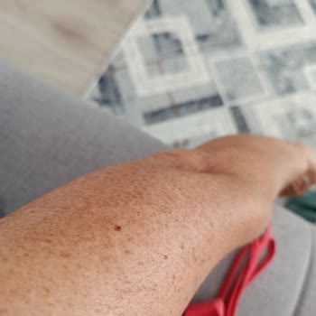 Celenes Güneş Kremi Kullanımından Şiddetli Yan Etki Ve Cilt Yanıkları