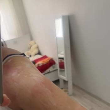 Lazer Epilasyon Yanığı, Saygısız Davranış Ve İade Reddi