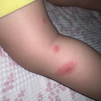 Grintuss Pediatrik Şurubu Çocuğumda Şiddetli Alerjik Reaksiyon Yarattı