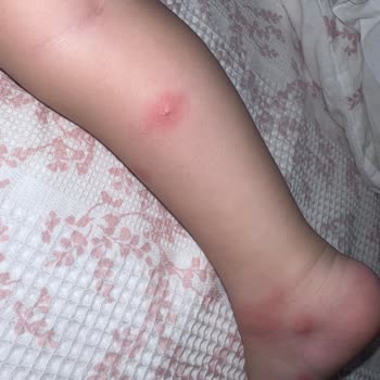 Grintuss Pediatrik Şurubu Çocuğumda Şiddetli Alerjik Reaksiyon Yarattı