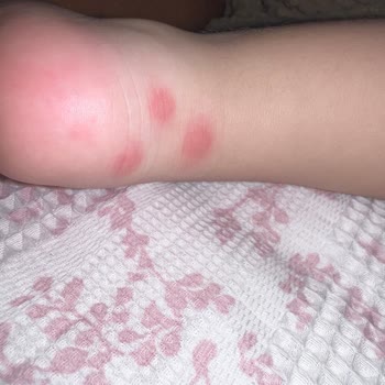 Grintuss Pediatrik Şurubu Çocuğumda Şiddetli Alerjik Reaksiyon Yarattı