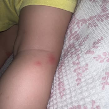 Grintuss Pediatrik Şurubu Çocuğumda Şiddetli Alerjik Reaksiyon Yarattı