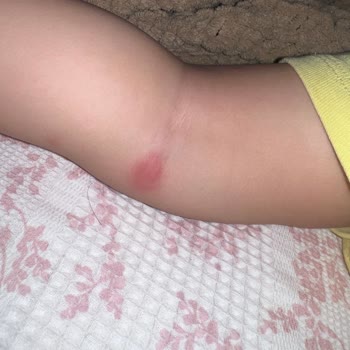 Grintuss Pediatrik Şurubu Çocuğumda Şiddetli Alerjik Reaksiyon Yarattı