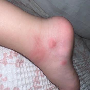 Grintuss Pediatrik Şurubu Çocuğumda Şiddetli Alerjik Reaksiyon Yarattı