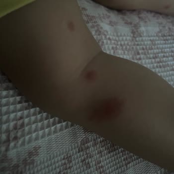Grintuss Pediatrik Şurubu Çocuğumda Şiddetli Alerjik Reaksiyon Yarattı