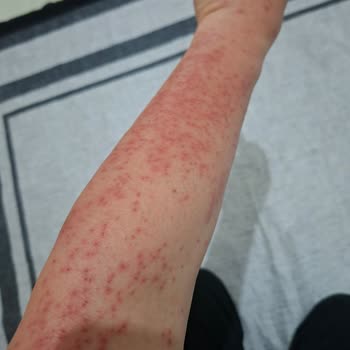 Gratis’ten Remove Tüy Dökücü Jel Kullanım Sonrası Cildi Şiddetli Tahriş Etti