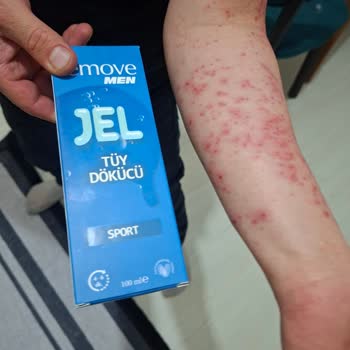 Gratis’ten Remove Tüy Dökücü Jel Kullanım Sonrası Cildi Şiddetli Tahriş Etti