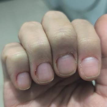 Bakırköy Fanes Nail Bar’da Manikür Sırasında Tırnak Kesildi Ve Kanama